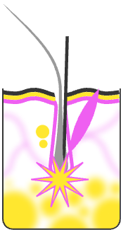 На конец иглы подается эл. импульс