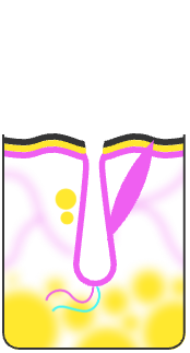 Волосяной фолликул погибает